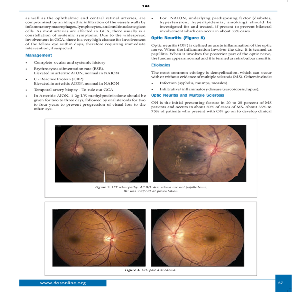 unilateral papillitis hyperemic disc edema